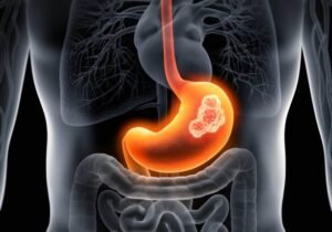 Expert GI Cancer Treatment in Vaishali