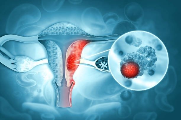 Expert Gynecological Cancer Treatment in Vaishali