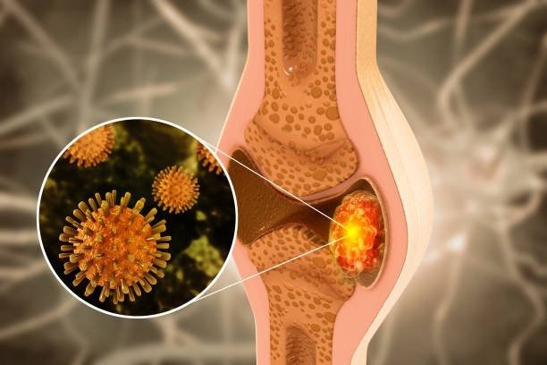 Expert Bone Cancer Treatment in Vaishali