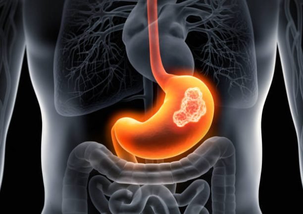 Medical x-ray  illustration of stomach cancer - stomach tumor