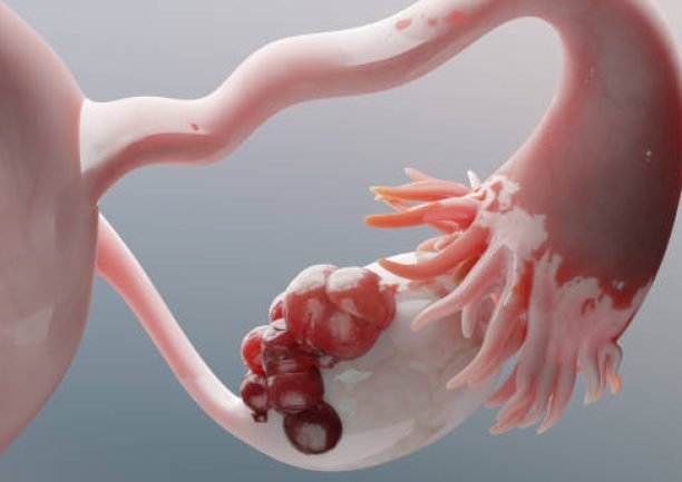 Ovarian malignant tumor, Female uterus anatomy, Reproductive system, cancer cells, ovaries cysts, cervical cancer, growing cells, gynecological disease, metastasis cancerous, duplicating, 3d render